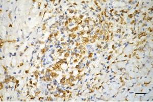 Immunohistochemistry was performed on paraffin-embedded human pancreatic adenocarcinoma using ferritin light chain antibody (ABIN7798597), 1:200). (FTL Antikörper)