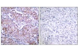 Immunohistochemical analysis of paraffin- embedded human breast carcinoma tissue, using (EGFR Antikörper  (pSer1070))