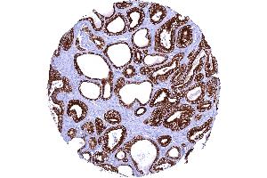 Prostatic adenocarcinoma Gleason 336 with strong AGR2 staining of all tumor cells (Rekombinanter AGR2 Antikörper)