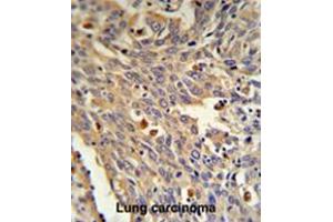 GLA Antibody (N-term) IHC analysis in formalin fixed and paraffin embedded human Lung carcinoma followed by peroxidase conjugation of the secondary antibody and DAB staining. (GLA Antikörper  (N-Term))