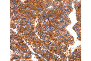 Immunohistochemistry of Human thyroid cancer using SEPT4 Polyclonal Antibody at dilution of 1:50 (Septin 4 Antikörper)