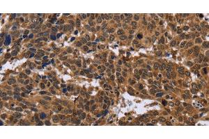 Immunohistochemistry of paraffin-embedded Human cervical cancer using EDN2 Polyclonal Antibody at dilution of 1:30 (Endothelin 2 Antikörper)