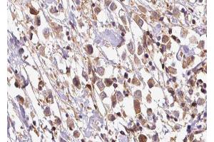 ABIN6278255 at 1/100 staining Human breast cancer tissue by IHC-P. (OS9 Antikörper  (Internal Region))
