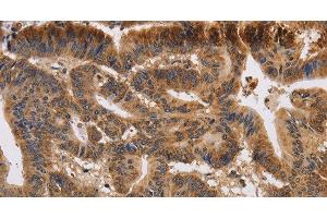 Immunohistochemistry of paraffin-embedded Human colon cancer using KCNK9 Polyclonal Antibody at dilution of 1:40