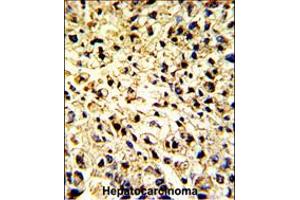 Formalin-fixed and paraffin-embedded human hepatocarcinoma with DCL-1 Antibody , which was peroxidase-conjugated to the secondary antibody, followed by DAB staining. (DCL1 Antikörper  (AA 143-170))