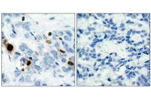 Immunohistochemical analysis of paraffin-embedded human breast carcinoma tissue using Histone H3. (HIST1H3A Antikörper  (pSer10))