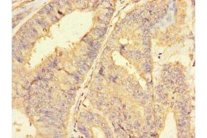 Immunohistochemistry of paraffin-embedded human endometrial cancer using ABIN7150164 at dilution of 1:100 (Retinoblastoma Binding Protein 8 Antikörper  (AA 126-331))