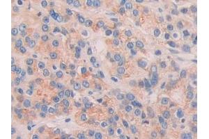 Detection of CHRD in Human Prostate cancer Tissue using Polyclonal Antibody to Chordin (CHRD) (Chordin Antikörper  (AA 700-918))
