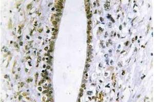 Immunohistochemistry (IHC) analyzes of Fes antibody in paraffin-embedded human liver carcinoma tissue. (FES Antikörper)
