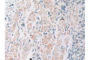 IHC-P analysis of Human Stomach Cancer Tissue, with DAB staining. (SIRT4 Antikörper  (AA 28-314))