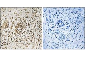Immunohistochemistry analysis of paraffin-embedded human breast carcinoma tissue, using CIB2 Antibody. (CIB2 Antikörper  (AA 21-70))