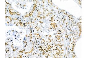 ABIN7093236 and ABIN7097248 at 1/100 staining Human lung cancer by IHC-P.