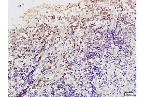 Formalin-fixed and paraffin embedded Human endometrium carcinoma labeled Anti-Livin Polyclonal Antibody, Unconjugated (ABIN672561) at 1:200, followed by conjugation to the secondary antibody and DAB staining (BIRC7 Antikörper  (AA 101-200))
