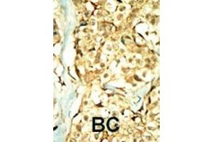 Formalin-fixed and paraffin-embedded human cancer tissue reacted with the primary antibody, which was peroxidase-conjugated to the secondary antibody, followed by DAB staining. (TNIK Antikörper  (N-Term))