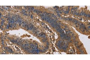 Immunohistochemistry of paraffin-embedded Human colon cancer tissue using KCNG1 Polyclonal Antibody at dilution 1:40 (KCNG1 Antikörper)