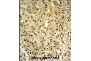 FYTD1 Antibody (N-term) (ABIN651416 and ABIN2840226) IHC analysis in formalin fixed and paraffin embedded human cervix carcinoma followed by peroxidase conjugation of the secondary antibody and DAB staining. (FYTTD1 Antikörper  (N-Term))