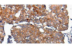Immunohistochemistry of paraffin-embedded Human breast cancer using FGF2 Polyclonal Antibody at dilution of 1:100 (FGF2 Antikörper)