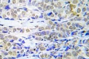Immunohistochemistry (IHC) analyzes of FOXO4 antibody in paraffin-embedded human lung adenocarcinoma tissue. (FOXO4 Antikörper)