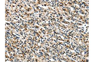 The image on the left is immunohistochemistry of paraffin-embedded Human prostate cancer tissue using ABIN7129612(GLP2R Antibody) at dilution 1/30, on the right is treated with fusion protein. (GLP2R Antikörper)