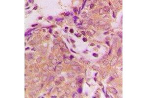 Immunohistochemical analysis of B3GALTL staining in human breast cancer formalin fixed paraffin embedded tissue section.