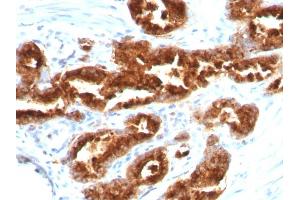 Formalin-fixed, paraffin-embedded human Prostate Carcinoma stained with TAG-72 Mouse Monoclonal Antibody (B72. (TAG-72 / CA72.4 Antikörper)