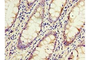 Immunohistochemistry of paraffin-embedded human colon cancer using ABIN7143229 at dilution of 1:100 (ACSM3 Antikörper  (AA 387-586))