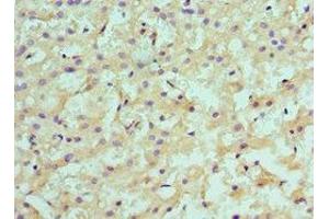Immunohistochemistry of paraffin-embedded human liver cancer using ABIN7145593 at dilution of 1:100 (SULT2A1 Antikörper  (AA 1-145))