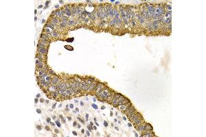 Immunohistochemistry of paraffin-embedded human metrocarcinoma using KRT5 antibody at dilution of 1:200 (400x lens). (Cytokeratin 5 Antikörper)