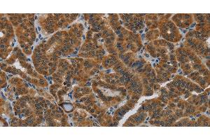 Immunohistochemistry of paraffin-embedded Human thyroid cancer using HSD3B7 Polyclonal Antibody at dilution of 1:40