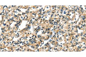 Immunohistochemistry of paraffin-embedded Human prostate cancer tissue using CK-17 Polyclonal Antibody at dilution 1:40 (KRT17 Antikörper)