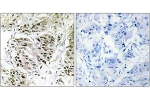 Immunohistochemistry analysis of paraffin-embedded human breast carcinoma, using CENPA Antibody. (CENPA Antikörper  (AA 11-60))
