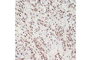 Immunohistochemistry of paraffin-embedded human gastric cancer using TDP-43/TARDB antibody (ABIN7270731) at dilution of 1:200 (40x lens). (TARDBP Antikörper  (AA 1-260))