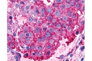 Anti-GPR116 antibody IHC of human Breast, Carcinoma. (G Protein-Coupled Receptor 116 Antikörper  (N-Term))