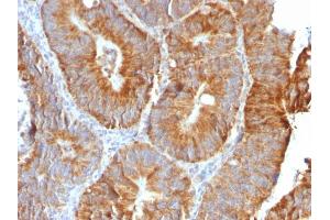 Formalin-fixed, paraffin-embedded human Colon Carcinoma stained with VEGI Rabbit Recombinant Monoclonal Antibody (VEGI /2052R). (Rekombinanter TNFSF15 Antikörper)