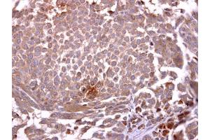IHC-P Image Glycophorin A antibody [C1C3] detects Glycophorin A protein at cytosol on human lung carcinoma by immunohistochemical analysis. (CD235a/GYPA Antikörper  (C-Term))