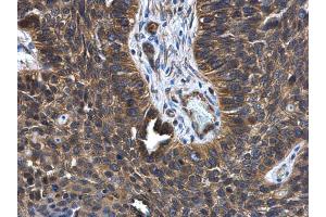 IHC-P Image FGD4 antibody [N1N3] detects FGD4 protein at cytoplasm in human lung cancer by immunohistochemical analysis. (FGD4 Antikörper)
