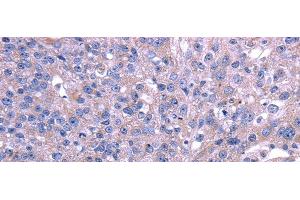 Immunohistochemistry of paraffin-embedded Human breast cancer using TRIM49 Polyclonal Antibody at dilution of 1/40 (TRIM49 Antikörper)