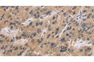 Immunohistochemistry of paraffin-embedded Human liver cancer tissue using CST6 Polyclonal Antibody at dilution 1:30 (CST6 Antikörper)