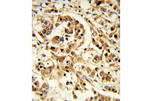 Formalin-fixed and paraffin-embedded human breast carcinoma reacted with IL12A Antibody (C-term), which was peroxidase-conjugated to the secondary antibody, followed by DAB staining. (IL12A Antikörper  (C-Term))