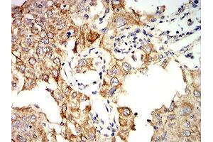 Immunohistochemical analysis of paraffin-embedded lung cancer tissues using KRT10 mouse mAb with DAB staining.