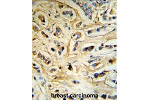 CASA Antibody (RB18742) IHC analysis in formalin fixed and paraffin embedded human breast carcinoma tissue followed by peroxidase conjugation of the secondary antibody and DAB staining. (Casein alpha S1 Antikörper  (AA 42-70))
