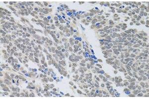 Immunohistochemistry of paraffin-embedded Human lung cancer using PAX3 Polyclonal Antibody at dilution of 1:100 (40x lens). (Paired Box 3 Antikörper)
