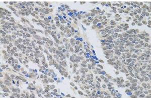 Immunohistochemistry of paraffin-embedded Human lung cancer using PAX3 Polyclonal Antibody at dilution of 1:100 (40x lens).