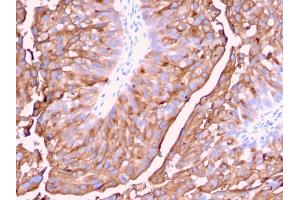 Formalin-fixed, paraffin-embedded human Urinary Bladder stained with Uroplakin 1A Mouse Monoclonal Antibody (UPK1A/2921). (UPK1A Antikörper  (AA 114-173))