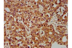 IHC image of ABIN7147569 diluted at 1:400 and staining in paraffin-embedded human liver cancer performed on a Leica BondTM system. (CLCC1 Antikörper  (AA 446-551))
