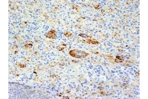 Formalin-fixed, paraffin-embedded human Erdheim Chester disease (also known as polyostotic lerosing histiocytosis) stained with TNF alpha antibody (TNFA/1172). (TNF alpha Antikörper)