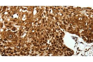 Immunohistochemistry of paraffin-embedded Human cervical cancer tissue using SCN1A Polyclonal Antibody at dilution 1:40 (SCN1A Antikörper)