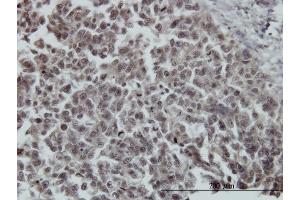 Immunoperoxidase of monoclonal antibody to FOXO3A on formalin-fixed paraffin-embedded human breast cancer. (FOXO3 Antikörper  (AA 361-460))