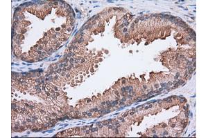 Immunohistochemical staining of paraffin-embedded Adenocarcinoma of Human colon tissue using anti-SNX9 mouse monoclonal antibody. (SNX9 Antikörper)