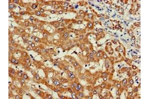 Immunohistochemistry of paraffin-embedded human liver cancer using ABIN7175855 at dilution of 1:100 (WISP3 Antikörper  (AA 201-372))